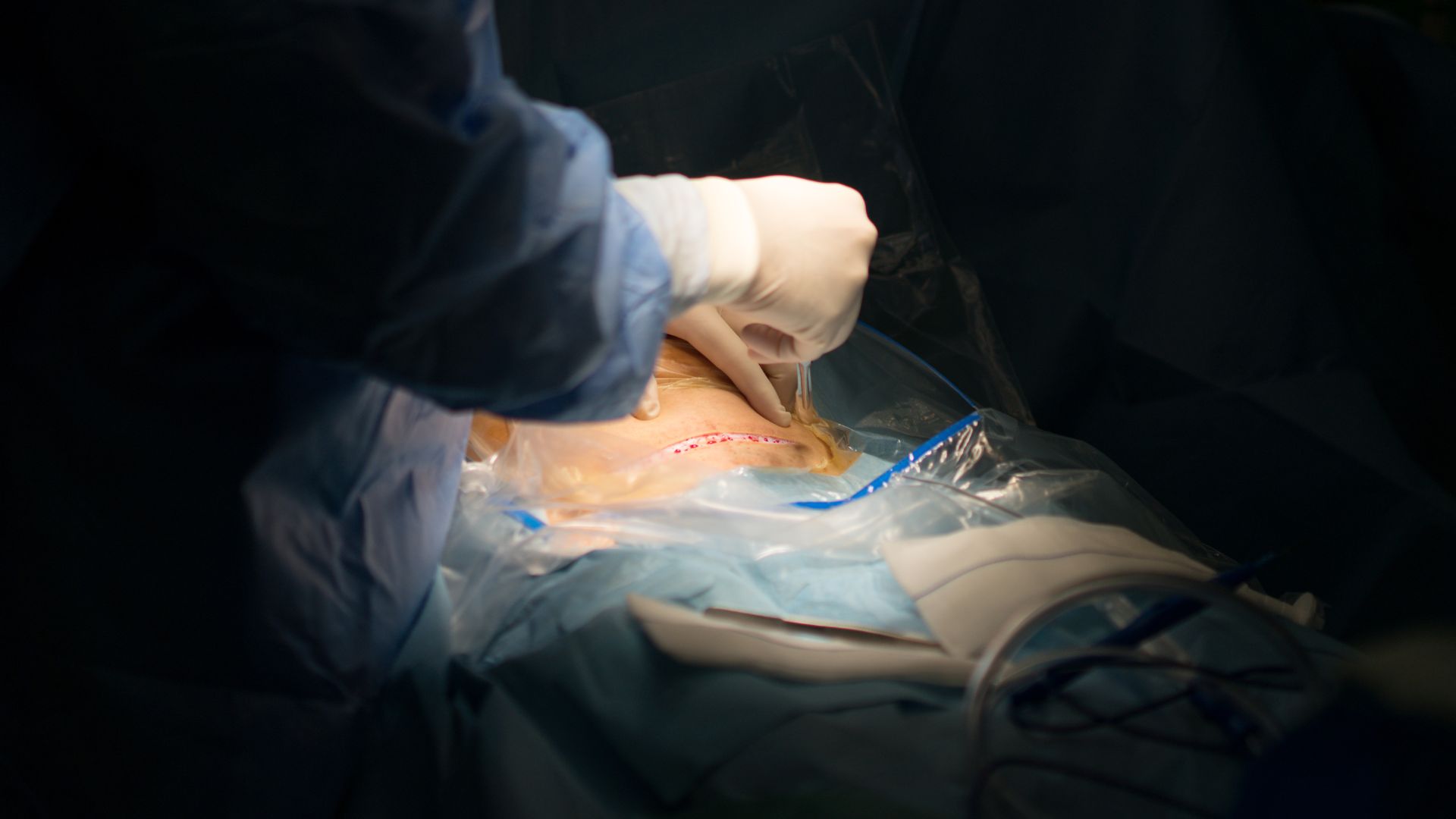 Vidéo : voici ce qui se passe vraiment dans votre corps pendant une césarienne, et c’est impressionnant